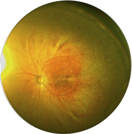 Ultra-widefield retinal image