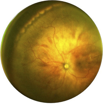 Ultra-widefield retinal image