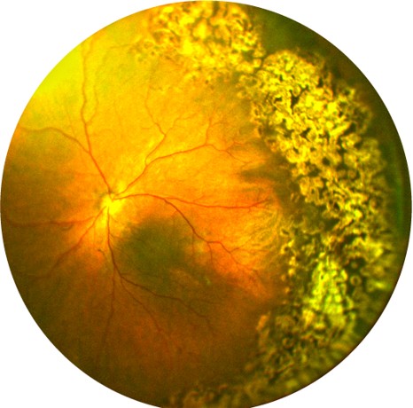 Ultra-widefield retinal image