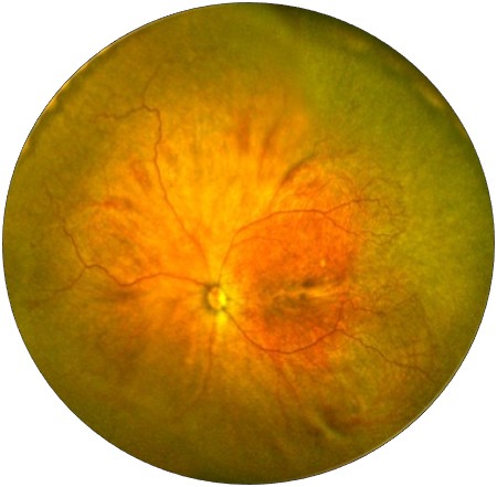 Ultra-widefield retinal image